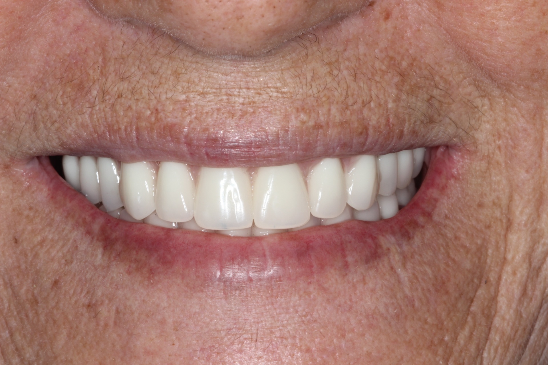 Prótese dentária · Dra. Vivian Nixson