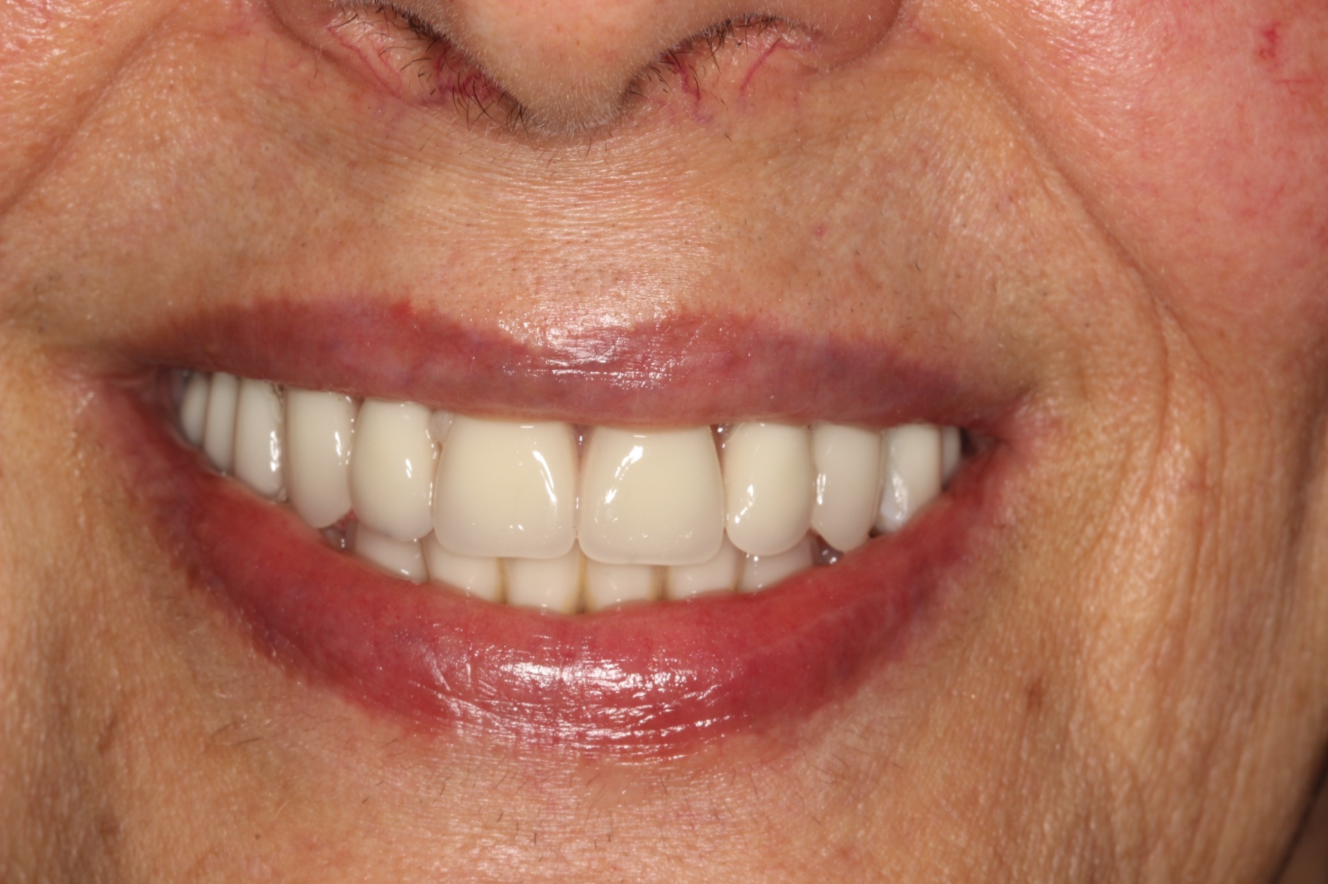 Prótese dentária · Dra. Vivian Nixson